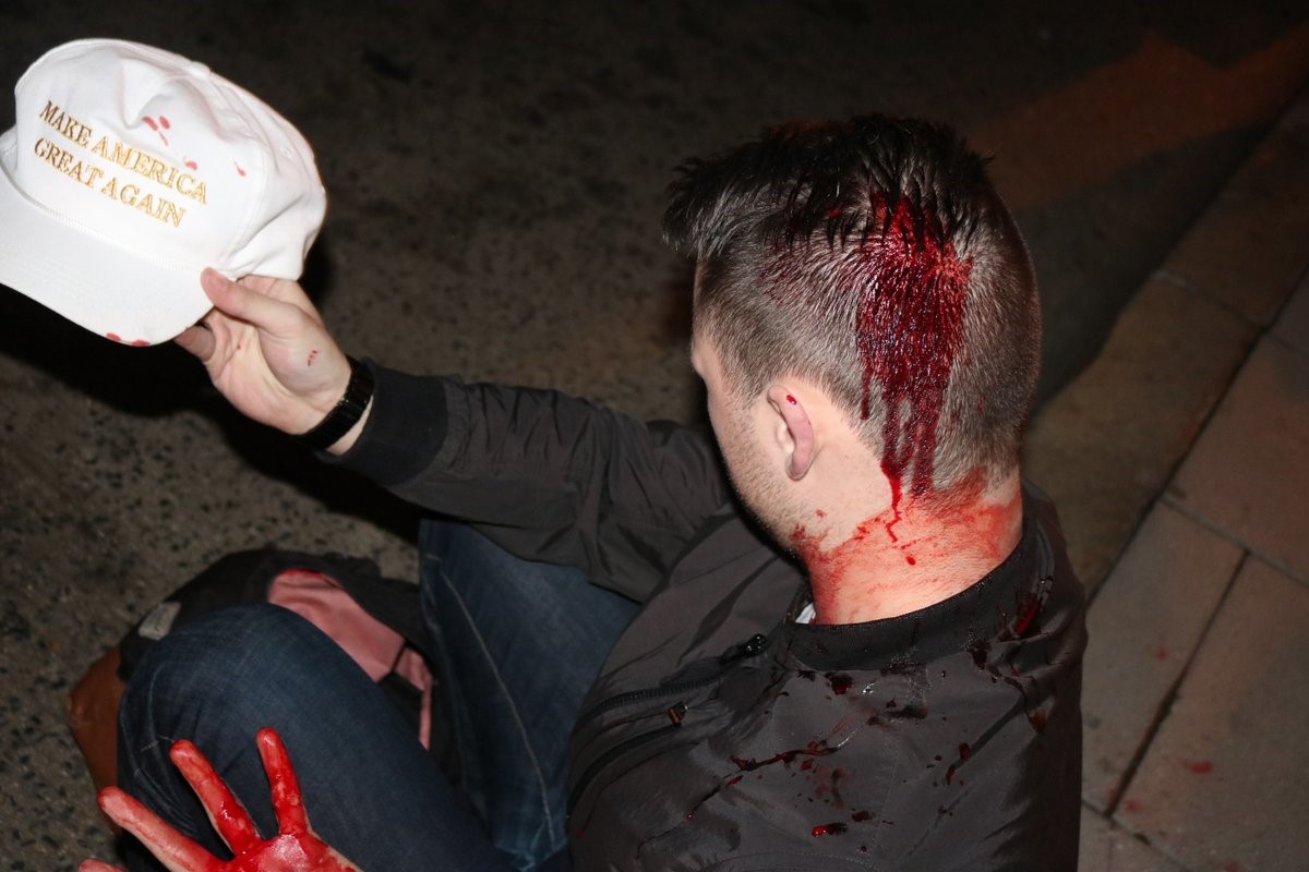 A young James Allsup was taken to the hospital following an attack by anti-White “Antifa” terrorists outside the DeploraBall, January 19, 2017.